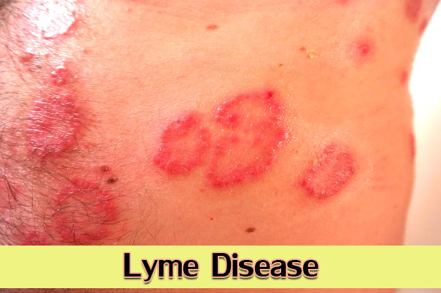 Lyme-Disease